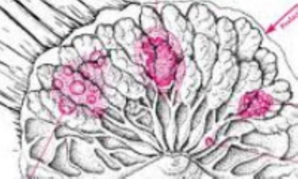 ترشح سینه و درمان آن ترشح سینه و درمان آن